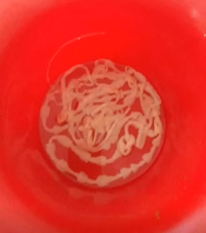 Con sán xơ mít kí sinh trong cơ thể người đàn ông suốt 43 năm qua.