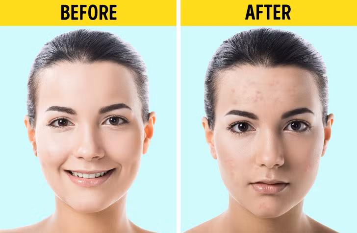 Dầu dừa là sản phẩm làm đẹp rất phổ biến. Tuy nhiên, nó không phải là lựa chọn tốt nhất để chăm sóc mặt. Dầu dừa làm cho da dầu, bít lỗ chân lông và có thể dẫn đến mụn trứng cá. Ảnh: BS.