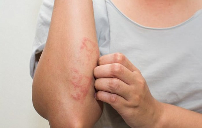 4. Nhiễm trùng da: Nếu bạn bị phát ban trên da, thậm chí đỏ và viêm mủ đau đớn, đặc biệt là nếu bạn là một người bơi thường xuyên, làn da của bạn có thể bị nhiễm trùng từ các hồ bơi. Một loại vi khuẩn được gọi là 'Pseudomonas aeruginosa' có mặt trong các bể bơi có thể gây nhiễm trùng da. Vì vậy, tắm rửa thật kỹ bằng xà phòng khử trùng sau mỗi lần bơi và giặt đồ bơi có thể giúp ngăn ngừa tình trạng này.