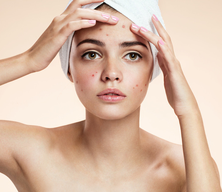 Mụn trứng cá hoặc phát ban da: Thiếu kẽm ảnh hưởng đến toàn bộ cơ thể và gây ra vấn đề với ruột và hệ miễn dịch. Điều này có thể dẫn đến dị ứng và gây mụn. Thực phẩm giàu kẽm bạn cần bổ sung là: hàu, thịt bò, thịt cừu, đậu...