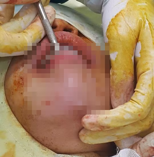 Chị Hoa phải thực hiện nạo, vét filler kém chất lượng. Ảnh: BSCC.