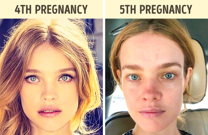 Quá trình mang thai cũng dẫn đến sự thay đổi sắc tố da trên khuôn mặt, đặc biệt là ở các vùng trán, mũi, cằm, xương gò má và mắt. Màu sắc của sắc tố này phụ thuộc vào màu da ban đầu của người mẹ: làn da trắng trở nên sẫm màu và tối hơn trở nên nhẹ hơn.