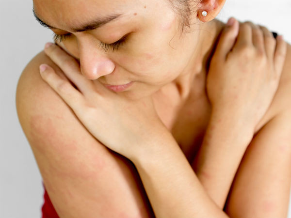 Lô hội làm giảm viêm da, trị mẩn đỏ trên cơ thể rất tốt vì nó có đặc tính kháng viêm. Tắm bằng nước ấm rồi cắt một lá lô hội lấy gel để bôi lên vùng da mẩn đỏ và đợi cho đến khi khô. Rửa sạch bằng nước ấm. Để có kết quả nhanh hơn, lặp lại cách này nhiều lần trong ngày.