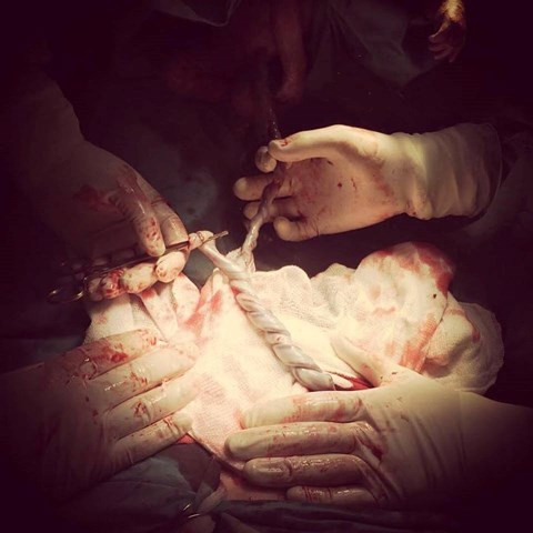 Ảnh dây rốn xoắn tít vào nhau.