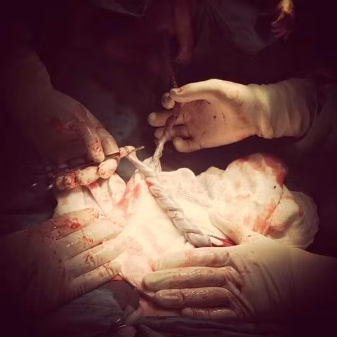 Ảnh dây rốn xoắn tít vào nhau.