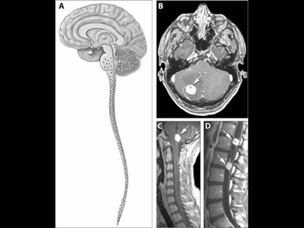 Bệnh Von Hippel-Lindau (VHL) gây ra khối u phát triển khắp cơ thể, đặc biệt là ở hệ thần kinh trung ương (não và tủy sống). Và mặc dù những khối u này có tính chất lành tính, nếu không được điều trị, chúng có thể gây đột quỵ hoặc đau tim, dẫn đến tử vong.