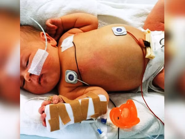 Bệnh Wolman ảnh hưởng đến trẻ sơ sinh. Bệnh gây tiêu chảy trầm trọng, sưng tấy và ruột, suy dinh dưỡng, sốt và chậm phát triển. Trẻ em bị bệnh này hiếm khi đạt tuổi dậy thì vì chúng thường chết do suy gan. Ảnh: Boldsky.