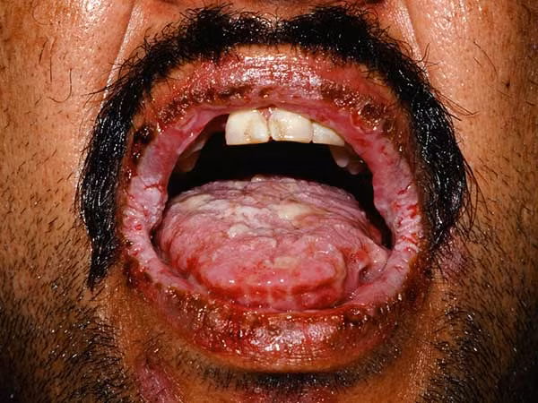 Pemphigus là một bệnh tự miễn dịch hiếm gặp. Biểu hiện của bệnh là sự phát triển của các bong bóng nước, đau đớn trên da và màng nhầy của cơ thể. 90% người bị bệnh này chết vì nhiễm khuẩn huyết, suy đa mãn, hoặc ung thư chuyển đổi khối u bên dưới.