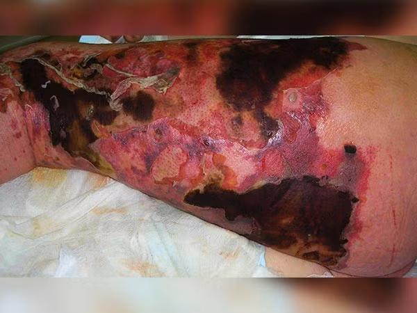 Viêm niệu hoãn tử hoại tử là một nhiễm trùng da và mô liên kết gây ra bởi nhiều loại vi khuẩn ăn thịt, loại phổ biến nhất là Staphylococcus aureus kháng methicillin. 25% người mắc bệnh này đã chết vì sự tàn phá nghiêm trọng mô cơ thể của họ.