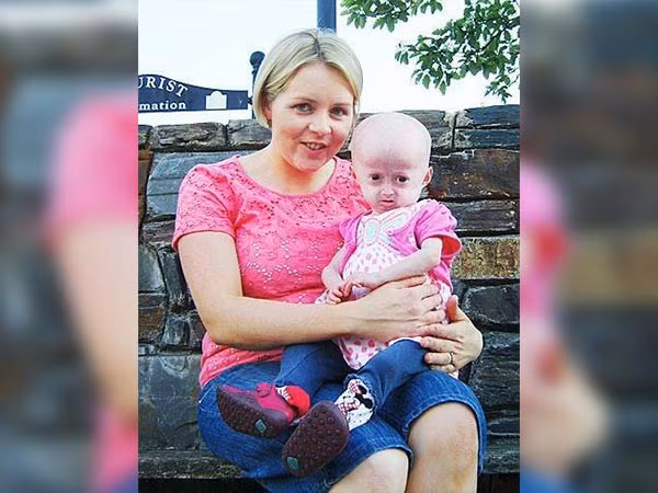 Progeria còn được gọi là Hutchinson-Gilford Progeria, là căn bệnh hiếm gặp, triệu chứng bề ngoài là lão hóa xuất hiện rất sớm. Người bệnh chỉ sống tới 14 tuổi và chết do các bệnh tuổi già.