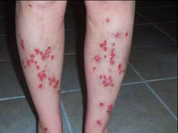 Morgellons là căn bệnh bí ẩn đến nỗi nhiều bác sĩ vẫn không tin rằng đó là một rối loạn thực sự. Morgellons là một hội chứng rối loạn da, làm cho người bệnh gần như phát điên vì luôn luôn cảm thấy ngứa ngáy không rõ nguyên nhân. Căn bệnh cũng không có thuốc chữa.