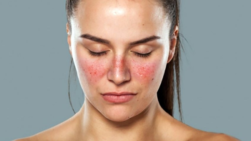 Lupus là một bệnh tự miễn mà khi bị bệnh, hệ thống miễn dịch sẽ tấn công da, khớp, phổi, thận, hệ thần kinh và mạch máu. Có bốn loại lupus, phổ biến nhất trong số đó là lupus ban đỏ hệ thống - ảnh hưởng đến cơ quan nội tạng. Hầu hết bệnh nhân bị lupus là phụ nữ và nhiều người trong số họ là khá trẻ. Vì lý do này, phụ nữ tuổi 20 nên thường xuyên kiểm tra sức khỏe.