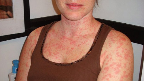 Phong tranh benh quai ac ca si Tuan Hung dang mac phai the nao?-Hinh-3