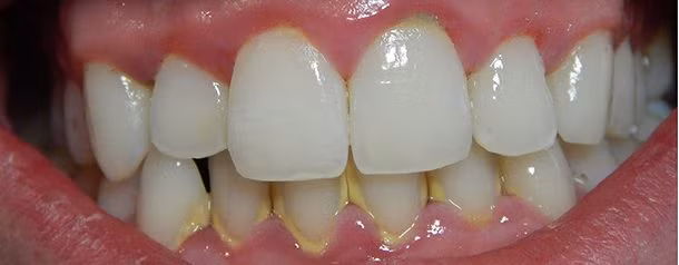 Ngăn chặn sự tích tụ cao răng: Bạn nên đánh răng ngày 2 lần để kiểm soát cao răng hoặc sử dụng nước súc miệng để loại đi các mảng bám tạo nên cao răng.