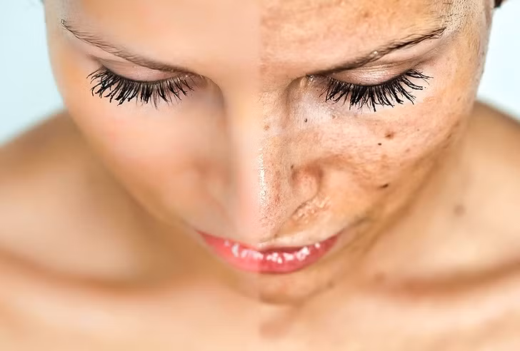 Sử dụng nước chanh để tẩy các vết sẹo, làm sáng da và các chứng khô da. Tất cả bạn cần làm là ép một trái chanh tươi lấy nước bôi vào những chấm đen hoặc mụn nhọt và để lại nó qua đêm.