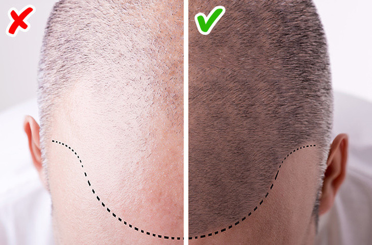 11. Một trong những triệu chứng bất thường nhất của các vấn đề về tim là rụng tóc sớm và nhiều ở nam giới.