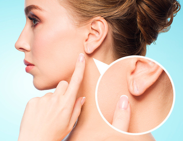 8. Nếp nhăn tai: Hơn 40 nghiên cứu xác nhận rằng nếp gấp thùy tai chéo, còn được gọi là dấu hiệu của Frank, cho thấy tăng nguy cơ xơ vữa động mạch.