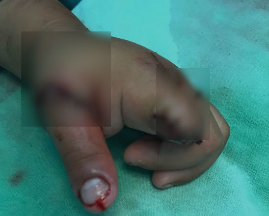 Ngoài những sự cố lao động, cũng có những tai nạn đáng tiếc trong đời sống hàng ngày. Ngày 8/3, Bệnh viện Chấn thương Chỉnh hình TP HCM đã tiếp nhận một bé trai 3 tuổi (quê Long An) nhập viện trong tình trạng đứt lìa ngón tay trỏ và ngón cái. Bé trai gặp nạn khi đưa tay vào líp xích xe máy chuẩn bị lăn bánh. May mắn, ê-kíp phẫu thuật đã thực hiện vi phẫu nối mạch máu, thần kinh giữ lại ngón cái cho bé.