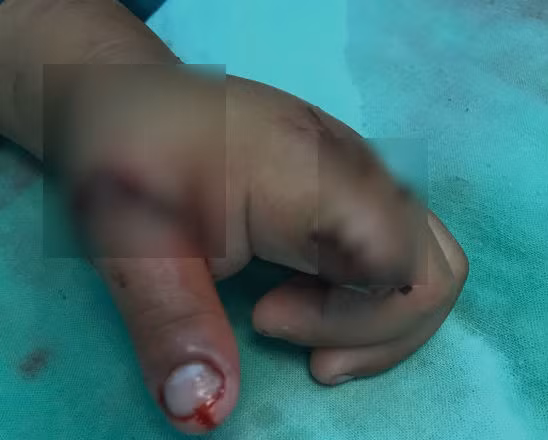 Ngoài những sự cố lao động, cũng có những tai nạn đáng tiếc trong đời sống hàng ngày. Ngày 8/3, Bệnh viện Chấn thương Chỉnh hình TP HCM đã tiếp nhận một bé trai 3 tuổi (quê Long An) nhập viện trong tình trạng đứt lìa ngón tay trỏ và ngón cái. Bé trai gặp nạn khi đưa tay vào líp xích xe máy chuẩn bị lăn bánh. May mắn, ê-kíp phẫu thuật đã thực hiện vi phẫu nối mạch máu, thần kinh giữ lại ngón cái cho bé.