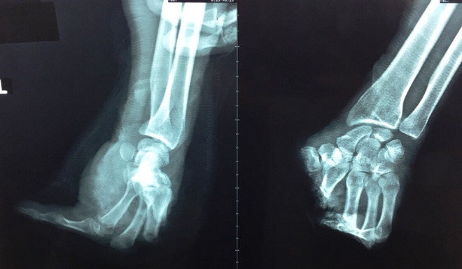 Mới đây, ngày 28/3, Bệnh viện Chấn thương Chỉnh hình TP HCM đã tiếp nhận một người đàn ông 54 tuổi (ngụ tại Bình Dương) được đưa vào viện cấp cứu trong tình trạng bàn tay trái nạn nhân đứt lìa cả 4 ngón, chỉ còn ngón út nguyên vẹn, nhiều mô dập nát. Theo người thân bệnh nhân bị thương, trong lúc làm việc người đàn ông gặp tai nạn hy hữu khi bất cẩn bị cưa máy cắt đứt bàn tay.