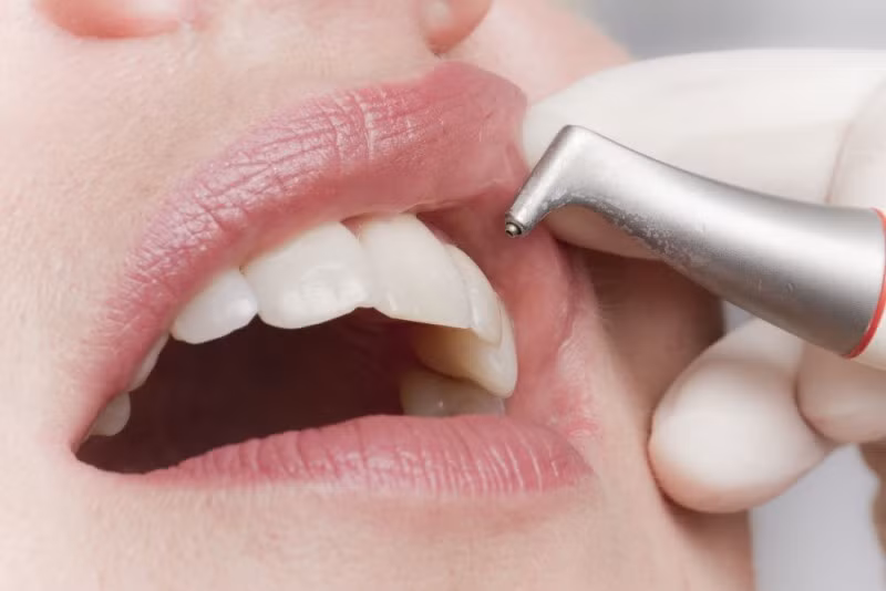 Bạn chỉ mất 3 đến 5 phút để nhỏ dung dịch florua vào chiếc răng đau, cơn đau sẽ dịu nhanh chóng.