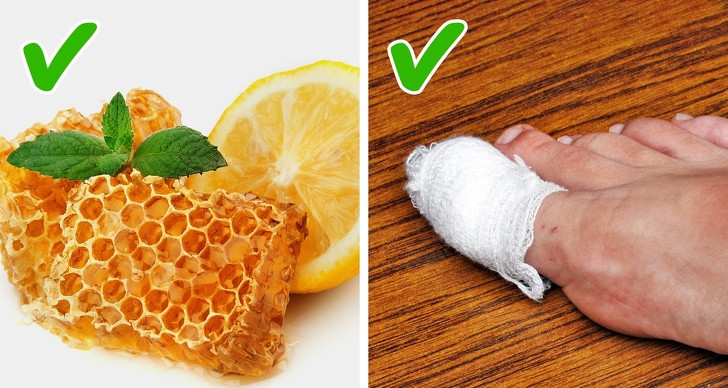 Bôi nước cốt chanh trộn mật ong lên ngón chân giúp ngăn nhiễm trùng khi móng đâm vào thịt.