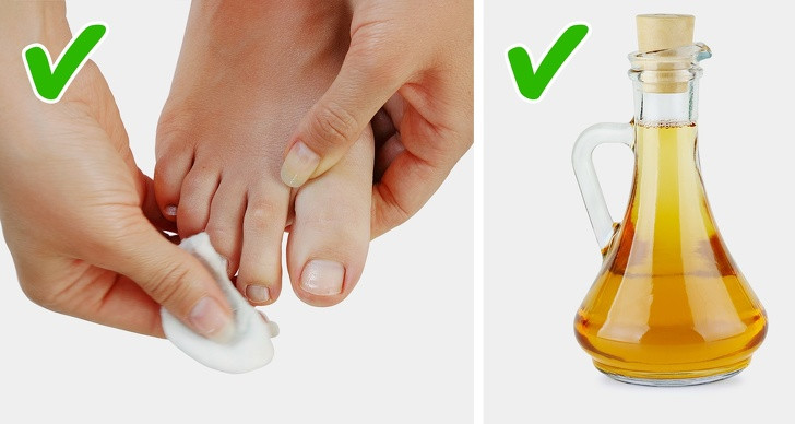 Dấm táo sẽ giúp bạn ngăn ngừa nhiễm trùng và làm giảm sưng da khi móng chân đâm vào thịt. Ngâm một quả bóng bông trong giấm táo rồi đắp lên vùng móng và cố định bằng băng dính trong vài giờ.