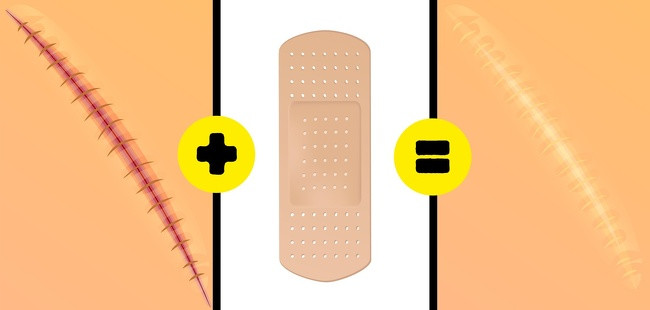 Nếu bạn có sẹo lồi và phì đại, hãy thử miếng silicone hoặc gel silicone. Bắt đầu sử dụng miếng silicone 2 tuần sau khi vết thương lành lại (12-24 giờ một ngày trong ít nhất 2 tháng). Gel silicone nên được sử dụng 1 lần/ngày cho đến khi sẹo mờ đi.