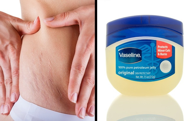 Vaseline là cách xóa sẹo hiệu quả và tiết kiệm. Thoa kem 3 lần/ngày trong vòng từ 1-3 tuần, sẽ giúp giữ ẩm cho làn da của bạn, phần da bị sẹo bớt khô và xù xì hơn.