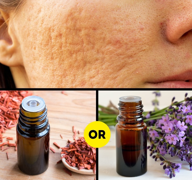 Tinh dầu gỗ đàn hương và hoa oải hương có thể hỗ trợ quá trình chữa lành và tái tạo da sẹo nếu được sử dụng thường xuyên.