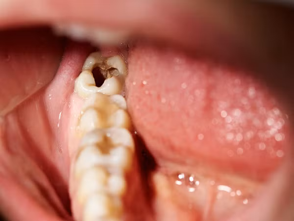 Ăn nhiều đường cũng có thể khiến bạn bị sâu răng. Vì vậy, nếu bạn nhận thấy những mảng ố đen trên các kẽ răng và cảm thấy đau khi bạn cắn một cái gì đó thì chắc chắn bạn đang ăn quá nhiều đường.