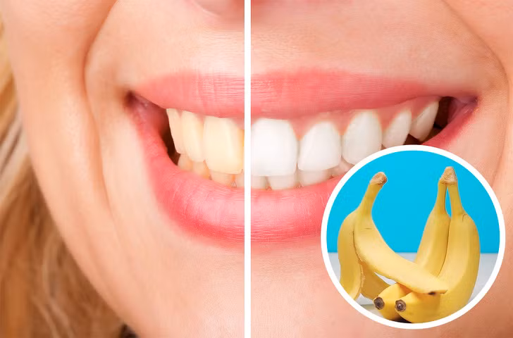 Sử dụng vỏ chuối để loại bỏ mảng bám răng. Việc chà răng bằng vỏ chuối trong 10-15 phút giúp làm trắng răng.