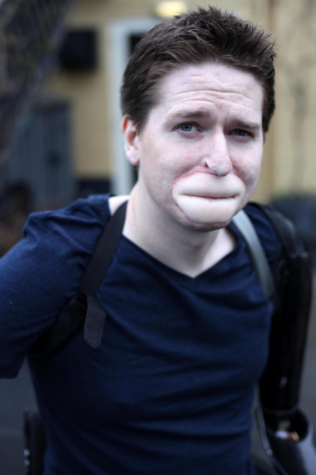 Hiện tại, sức khỏe của Alex Lewis đã hoàn toàn ổn định sau 5 năm kể từ ngày gặp phải căn bạo bệnh tai ác.