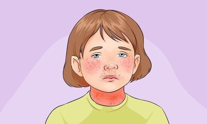 Rubella là một bệnh truyền nhiễm nguy hiểm ở trẻ. Một triệu chứng quan trọng của rubella là phát ban xuất hiện vào ngày thứ 3 sau lần nhiễm đầu tiên. Nốt ban thường xuất hiện xung quanh tai, phần phía trước của cổ và má.