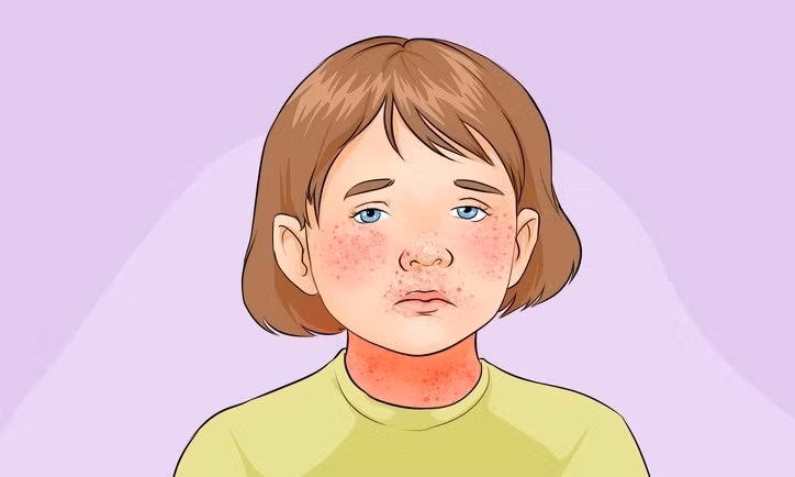 Cach nhan biet 10 benh thuong gap o tre nho-Hinh-10