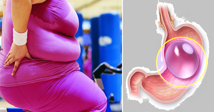 Thêm 5 người tử vong do bong bóng giảm cân, nâng tổng số lên 12 người từ năm 2016.