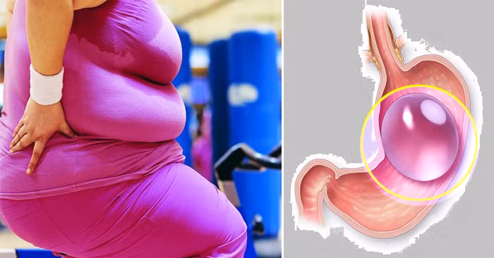 Thêm 5 người tử vong do bong bóng giảm cân, nâng tổng số lên 12 người từ năm 2016.