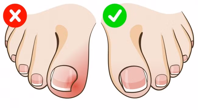 Cắt cụt móng chân quá mức sẽ khiến bạn gặp khó khăn khi đeo tất và đi bộ. Khi móng chưa kịp mọc, lớp da chân sẽ chèn lên, gây sưng phù khi bạn đi bộ nhiều. Ảnh: Depositphotos.