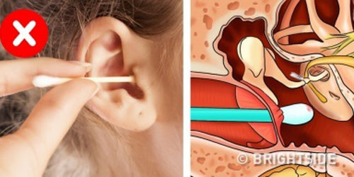 Hầu hết chúng ta đều tin rằng bông ngoáy tai sẽ giúp làm tai sạch sẽ. Thực tế, đây chỉ là thói quen vệ sinh cá nhân sai lầm bởi bông gòn có thể đẩy chất bẩn trong tai vào sâu hơn, làm hỏng màng nhĩ, mất thính giác...