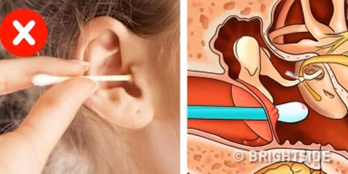 Hầu hết chúng ta đều tin rằng bông ngoáy tai sẽ giúp làm tai sạch sẽ. Thực tế, đây chỉ là thói quen vệ sinh cá nhân sai lầm bởi bông gòn có thể đẩy chất bẩn trong tai vào sâu hơn, làm hỏng màng nhĩ, mất thính giác...