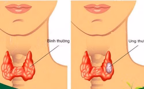 Cach phat hien u tuyen giap de thoat an tu-Hinh-2