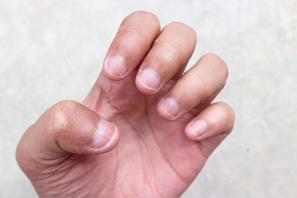 Cắn móng tay là một thói quen xấu có thể gây ra các chứng bệnh nguy hiểm và làm giảm tuổi thọ nếu thực hiện thường xuyên.