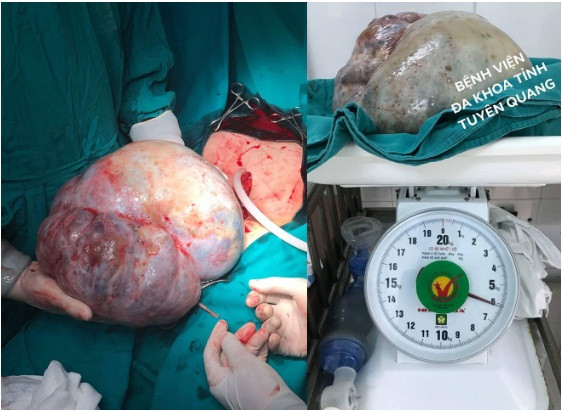 Khối u khổng lồ nặng 6,2 kg của bệnh nhân.