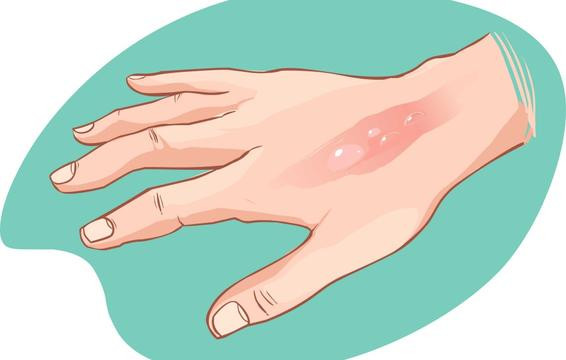 Bạn bị thương vì không có cảm giác đau đớn, hãy đến gặp bác sĩ ngay.