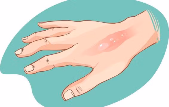 Bạn bị thương vì không có cảm giác đau đớn, hãy đến gặp bác sĩ ngay.