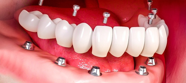 Ngoài phương pháp bọc răng sứ, sao Hollywood còn chọn cách trồng răng mới để có được nụ cười rạng rỡ. Với phương pháp này, bạn phải nhổ hết răng thật và sống với bộ răng giả suốt phần đời còn lại.