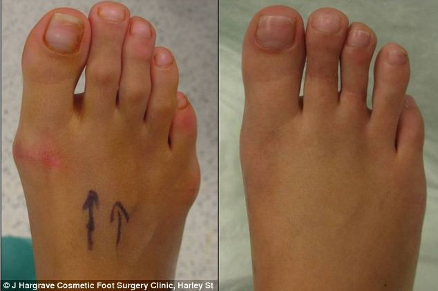 Phẫu thuật Cinderella là phương pháp mỹ phẩm tái tạo bàn chân phụ nữ để dễ dàng đi bộ bằng giày cao gót.