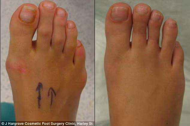 Phẫu thuật Cinderella là phương pháp mỹ phẩm tái tạo bàn chân phụ nữ để dễ dàng đi bộ bằng giày cao gót.