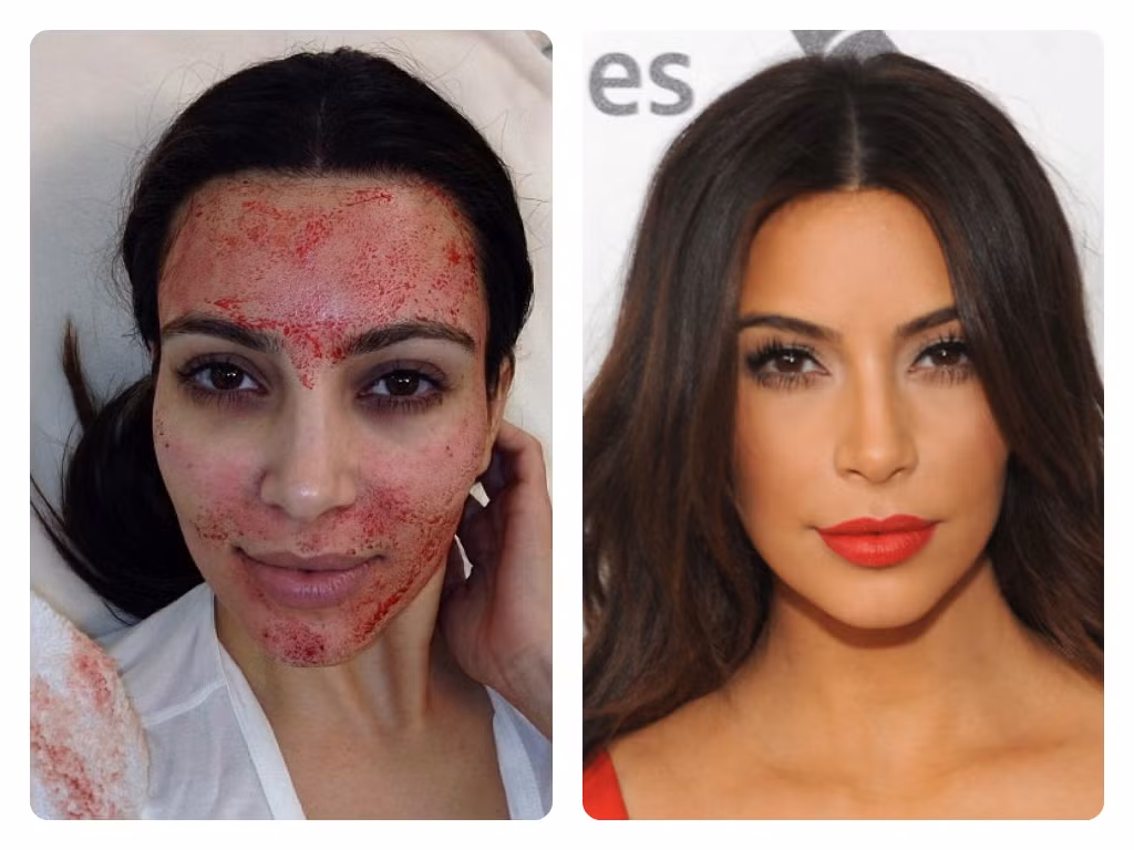 Đắp mặt bằng máu là phương pháp làm đẹp lạ đời của Kim Kardashian. Đầu tiên, bác sĩ sẽ lấy máu của Kim rồi tiêm nó vào khuôn mặt cô ấy bằng những chiếc kim rất nhỏ dưới dạng huyết tương giàu tiểu cầu. Quy trình này được cho là giúp trẻ hóa khuôn mặt và ngăn ngừa các nếp nhăn.