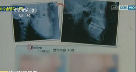 Đến ngày 24/7, sau một tháng hôn mê, người phụ nữ này đã qua đời. Vụ việc đã làm dấy lên làn sóng bất bình trong dư luận Hàn Quốc - nơi vẫn được xem là thiên đường của phẫu thuật thẩm mỹ. Ảnh: Internet. 